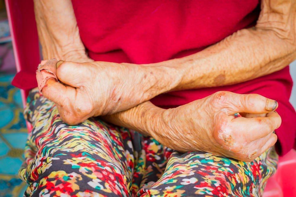 Knowing Leprosy Alias â€‹â€‹Leprosy, Diseases that are often late detected