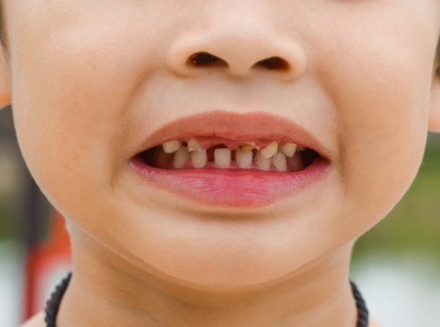 5 Penyebab Gigi Anak Rusak dan Tips Perawatannya