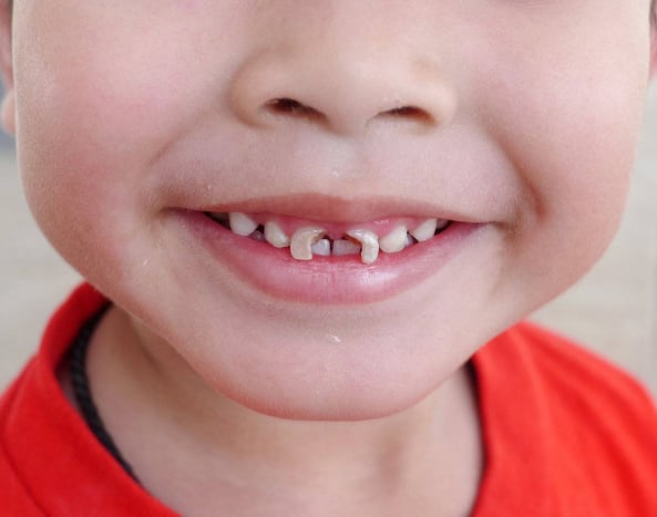 mencegah gigi berlubang pada anak