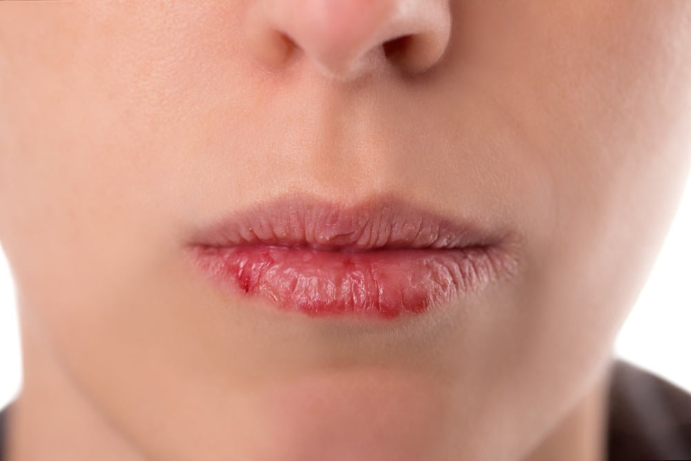 Cara Ampuh Mencegah dan Cara Mengatasi Bibir Kering