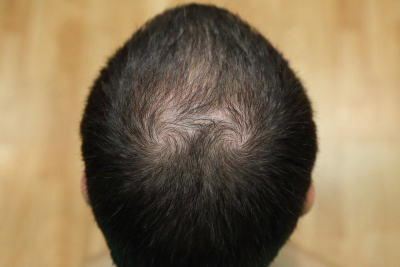 kebotakan alias alopecia