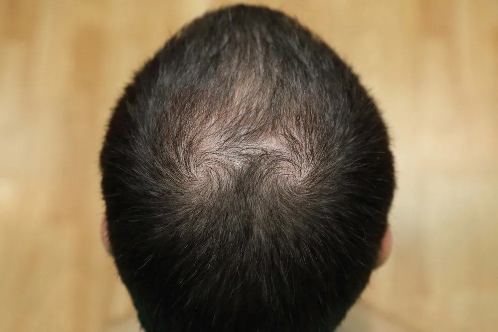 Alopecia (Kebotakan)