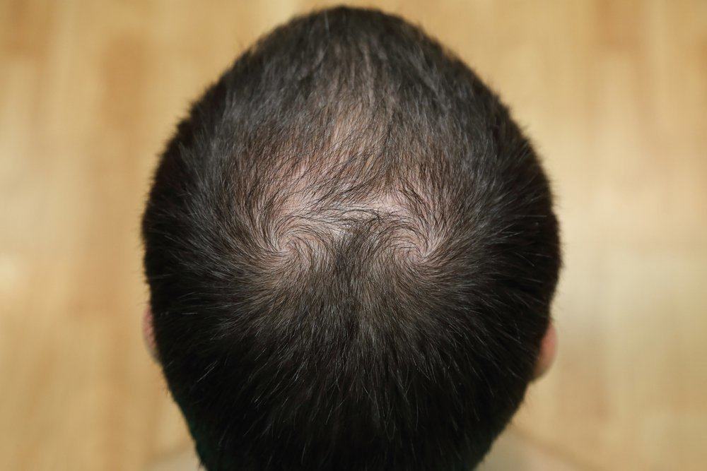 Alopecia (Kebotakan)