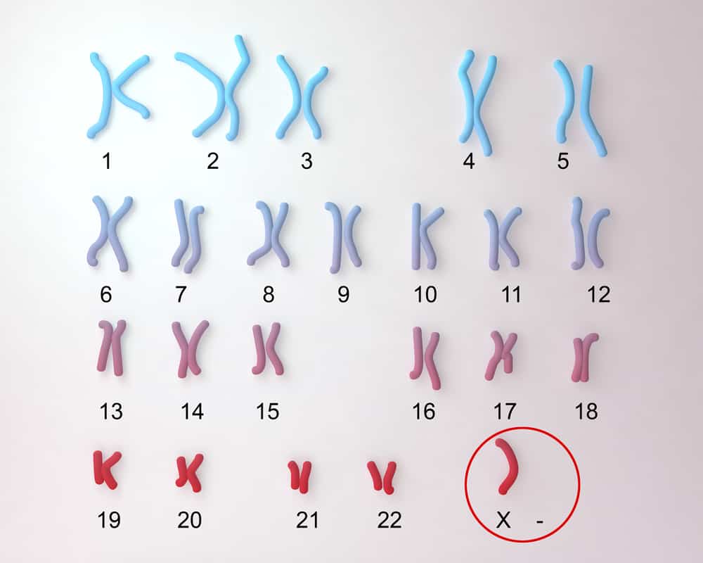 Sindrom Turner, Kelainan Kromosom yang Terjadi pada Perempuan