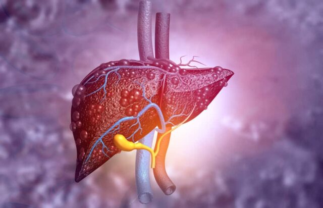 Sirosis Bilier Primer (Primary Biliary Cholangitis)