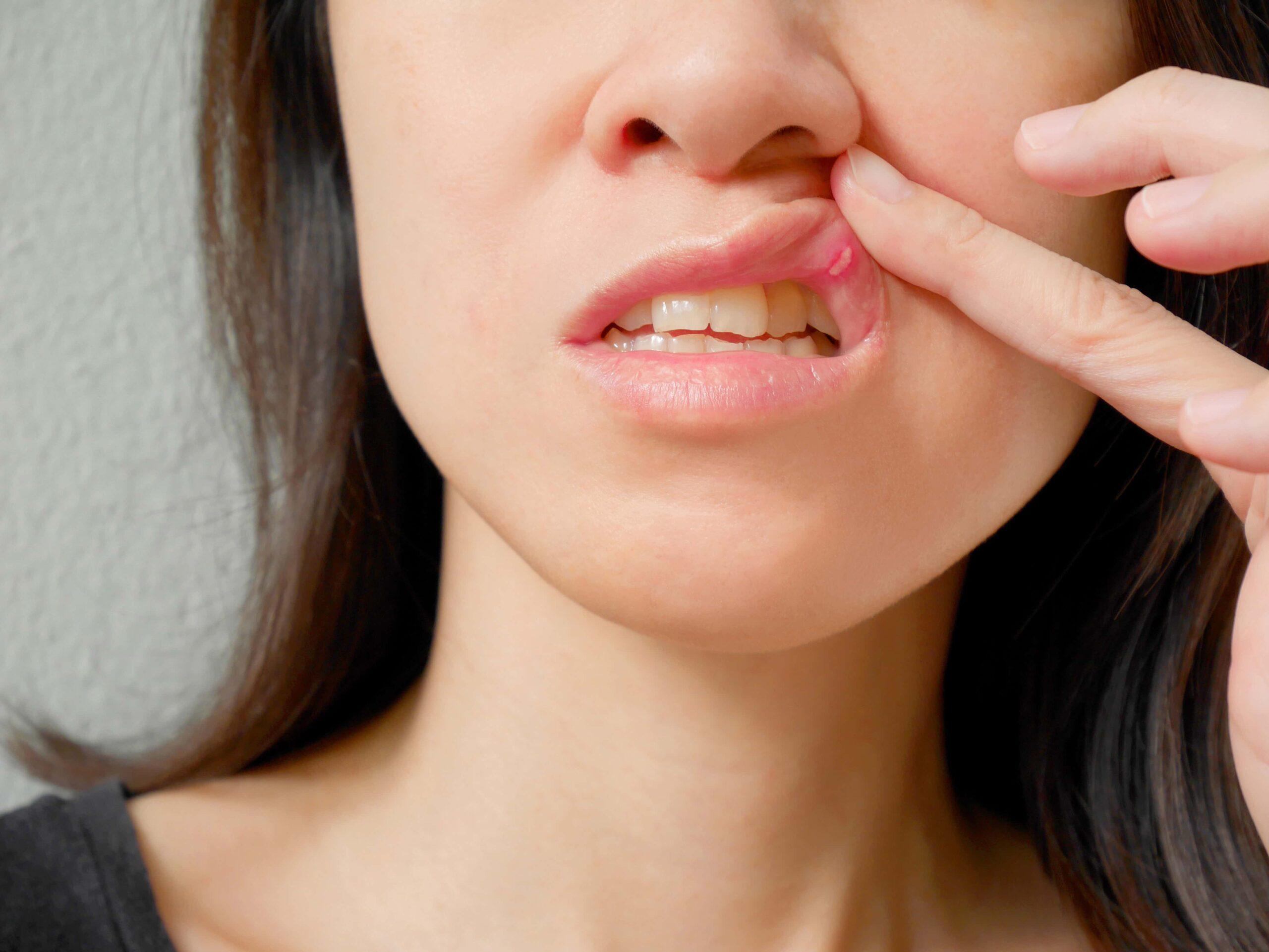 Radang Mulut (Mouth Ulcer)