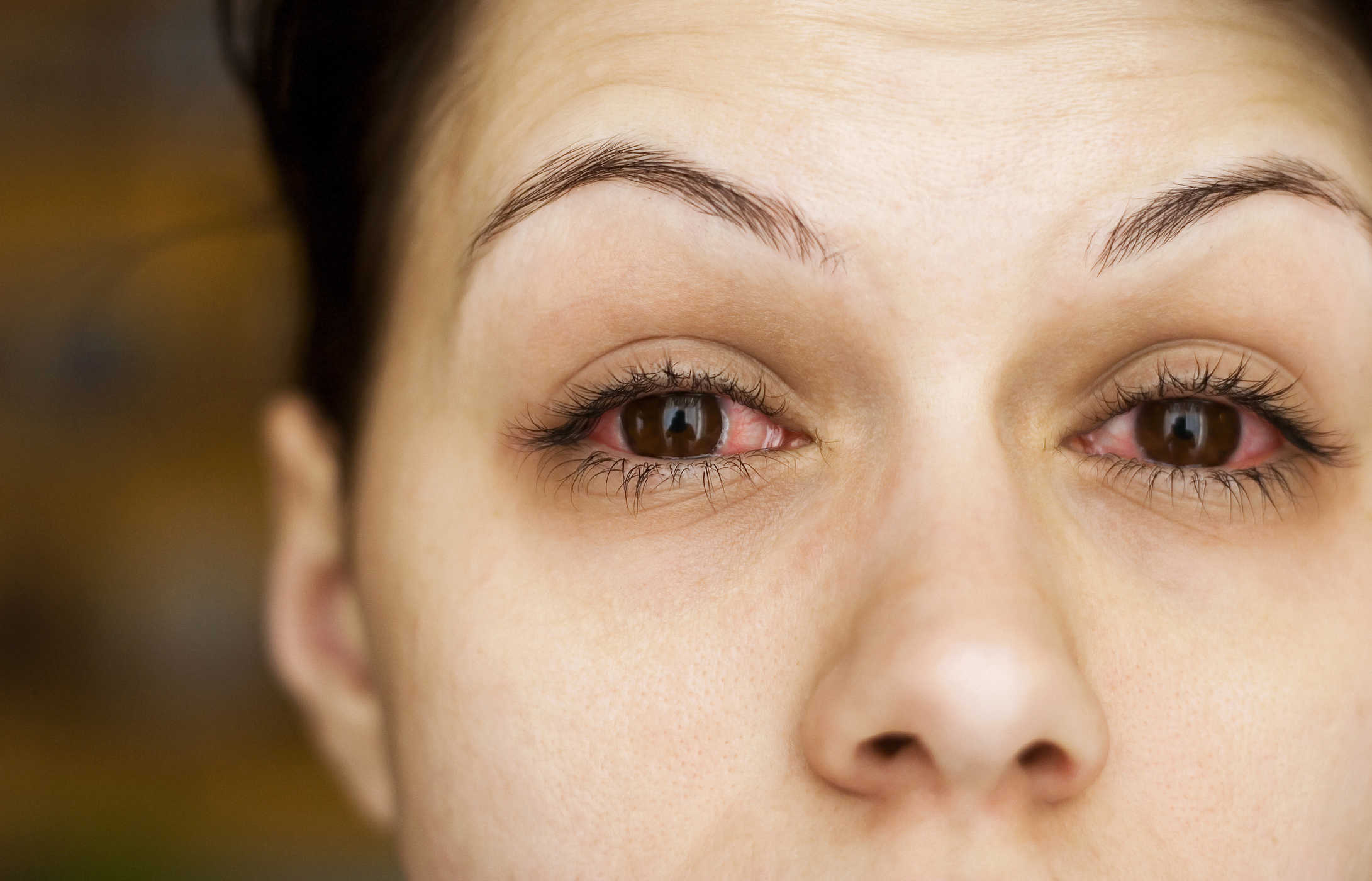 Mengenali Infeksi Mata Akibat Penggunaan Lensa Kontak