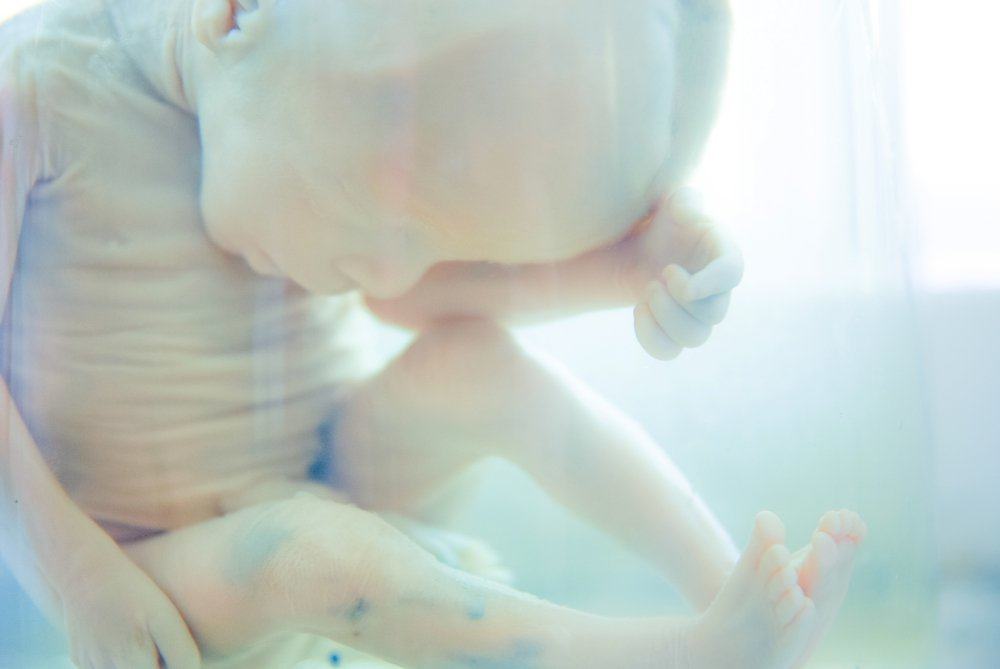 Stillbirth (Bayi Lahir Mati): Penyebab, Tanda, dan Cara Mencegahnya