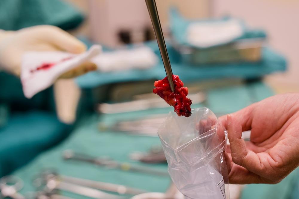 Biopsi Kelenjar Getah Bening