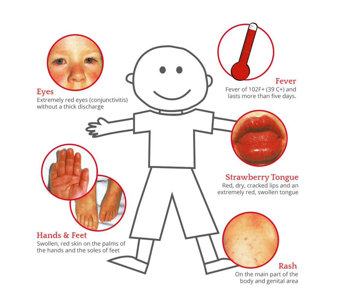 Anak Demam Disertai Ruam Merah Waspada Penyakit Kawasaki Hello Sehat