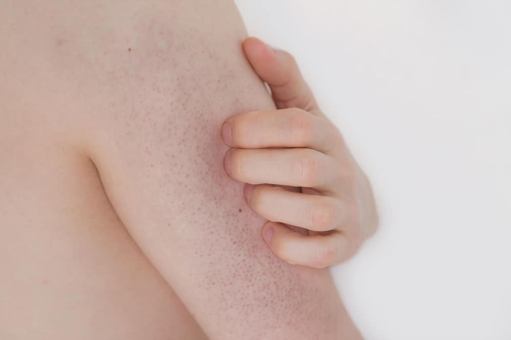 Keratosis Pilaris (Penyakit Kulit Ayam)