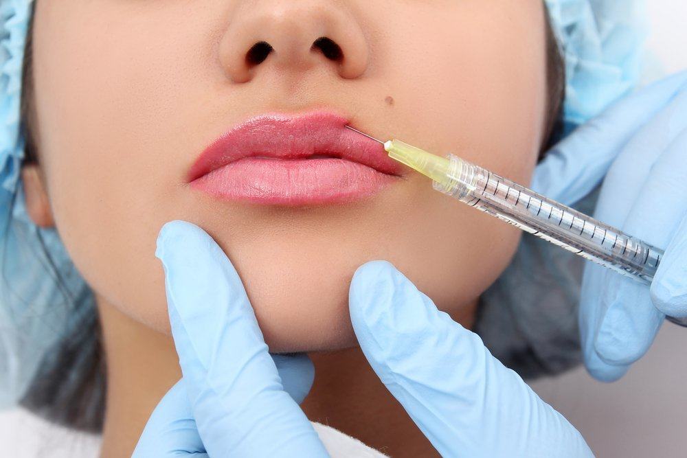 Manfaat dan Risiko Menebalkan Bibir Dengan Lip Filler