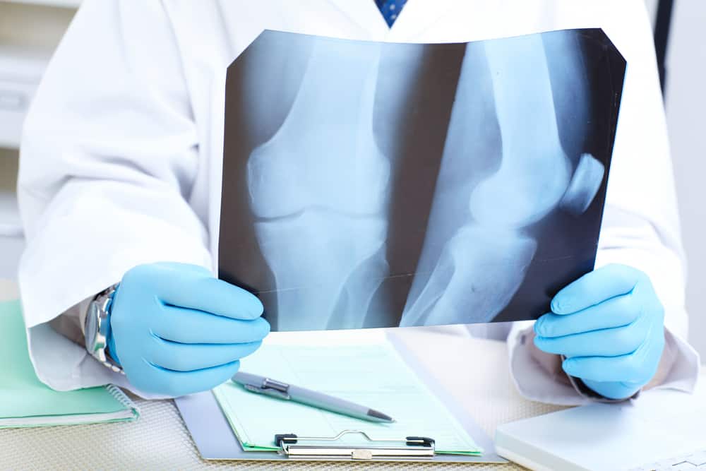 Osteoporosis (Pengapuran Tulang)