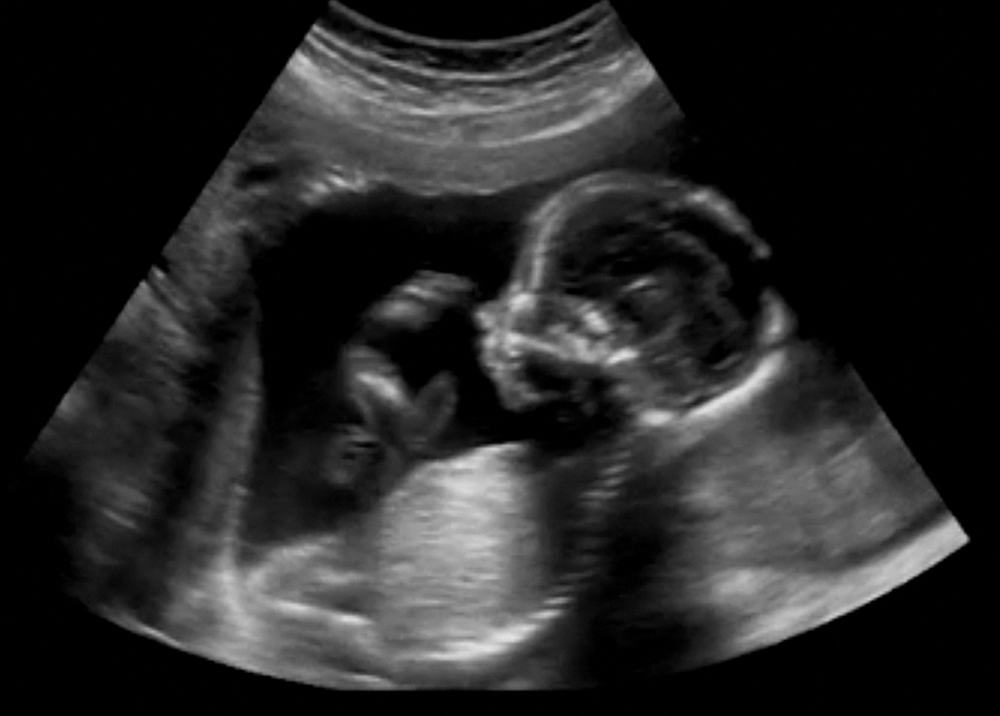 Berbagai Penyebab Bayi Lahir Dalam Keadaan Meninggal (Stillbirth)