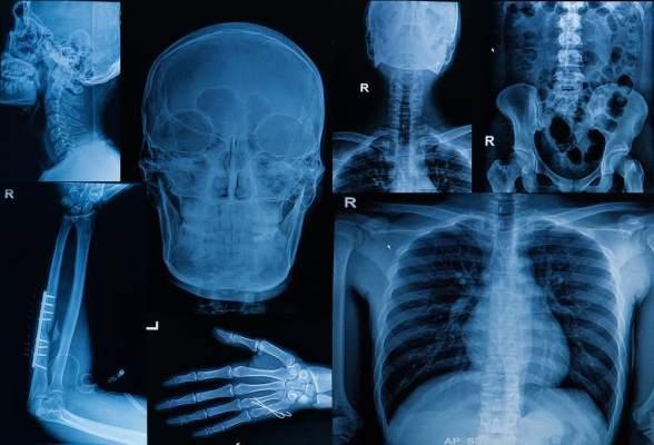 Mengenal Empat Jenis Penyakit Tulang yang Langka
