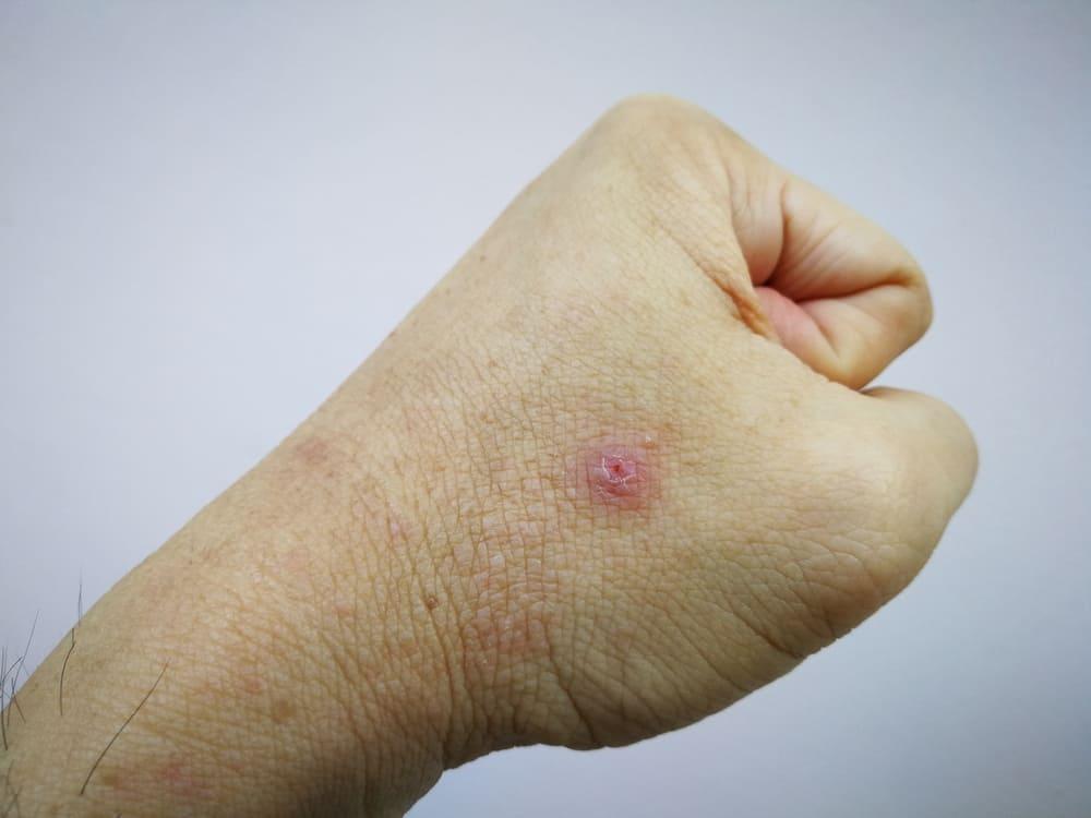 Moluskum Kontagiosum (Molluscum Contagiosum)