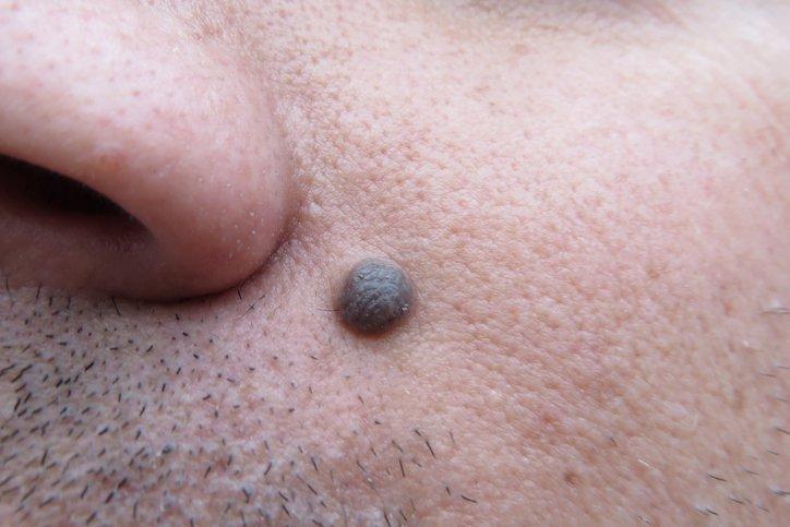 Perbedaan Tahi Lalat Akibat Kanker Kulit dengan Tahi Lalat Normal