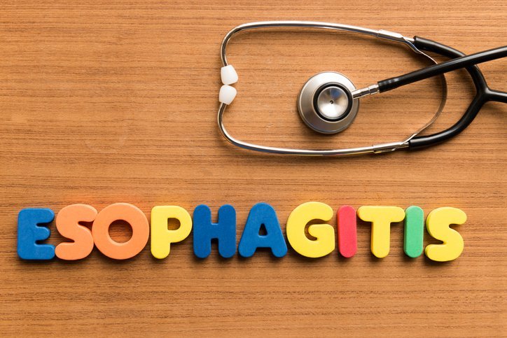 Penyebab dan Cara Mengobati Esofagitis (Radang Kerongkongan)