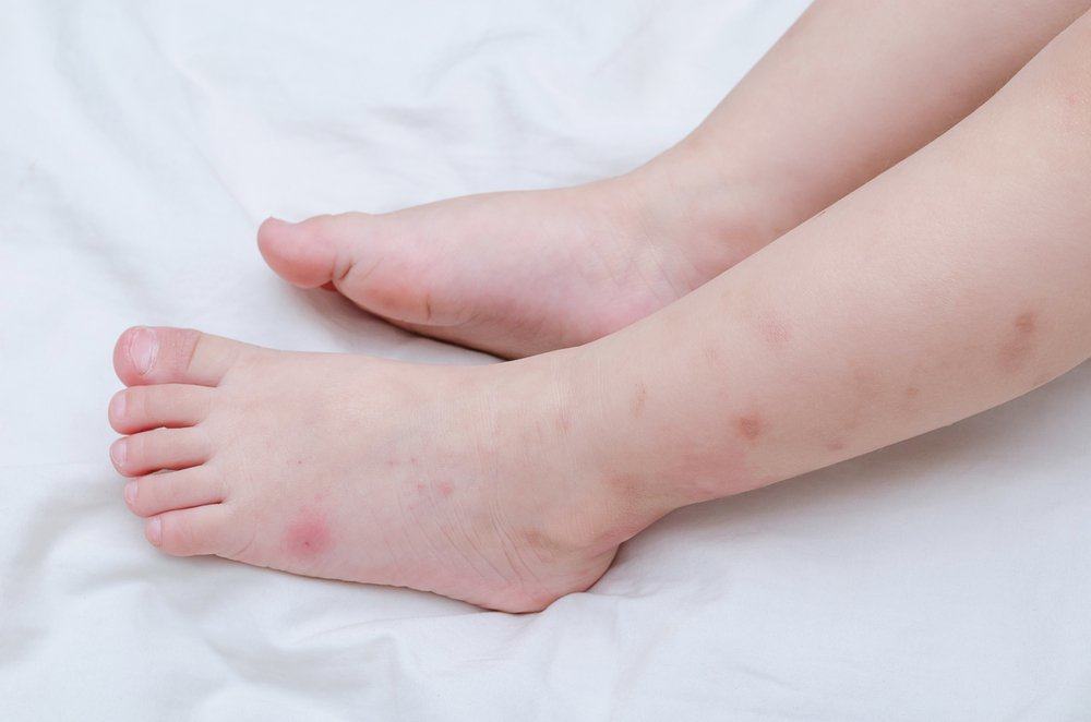 Waspadai Gejala Demam Berdarah Dengue (DBD) pada Anak