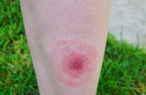 penyakit lyme disease, lyme disease adalah