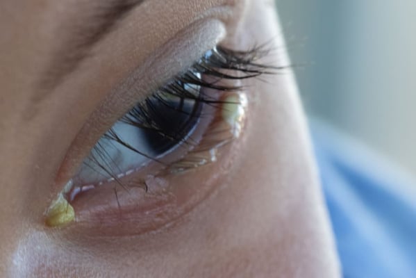 Opname dutje Verniel Penyebab Mata Belekan dan Cara Mengatasinya - Hello Sehat
