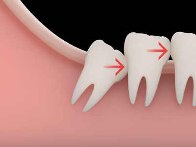 Risiko dan Cara Atasi Gigi Bungsu Bermasalah