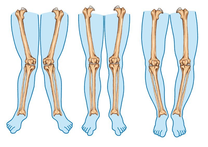 Apa yang Menyebabkan Bentuk Kaki O dan X?