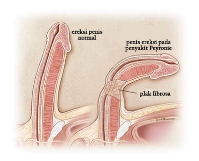 tanda penyakit peyronie