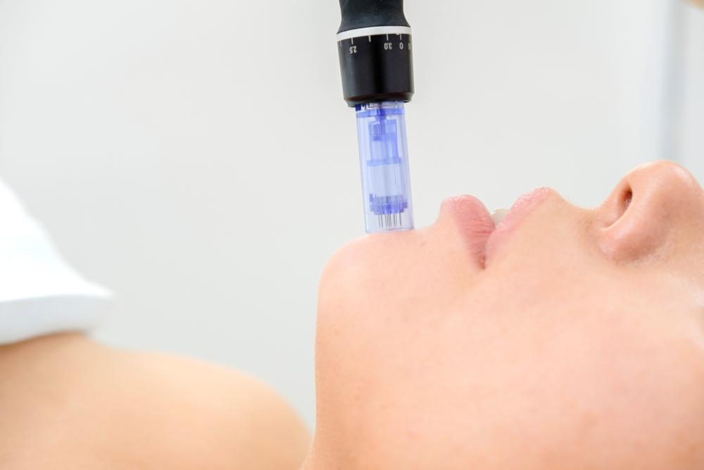 Microneedling, Menyulap Kulit Jadi Awet Muda dengan Jarum Halus