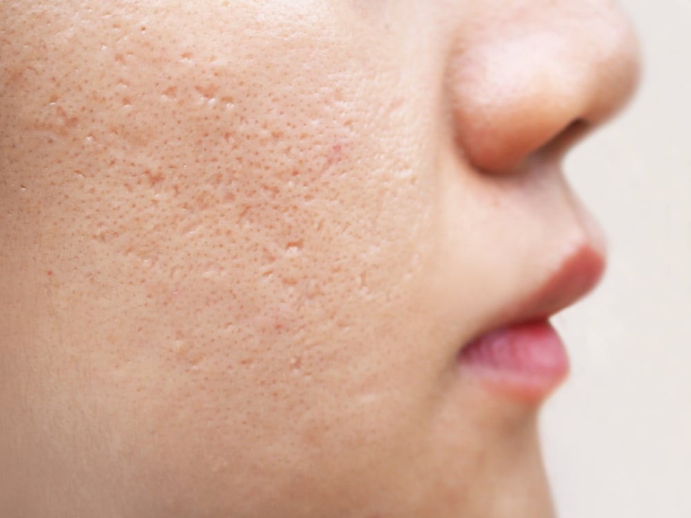 Microneedling: Pengertian, Prosedur, dan Efek Samping