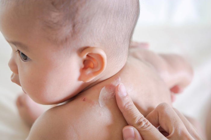 Gigitan Nyamuk, bintik merah atau ruam pada kulit bayi
