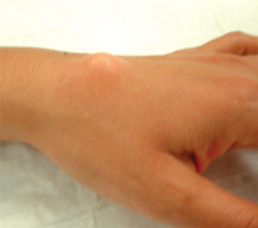 Kista ganglion pada pergelangan tangan atas (sumber: American Society for Surgery of the Hand)