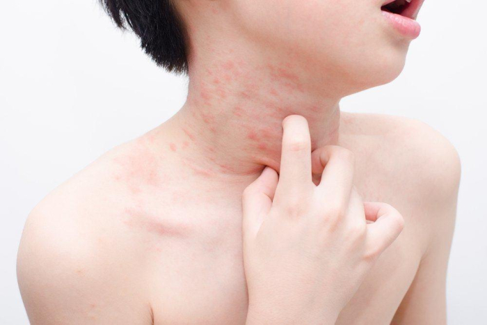 obat alergi dingin adalah