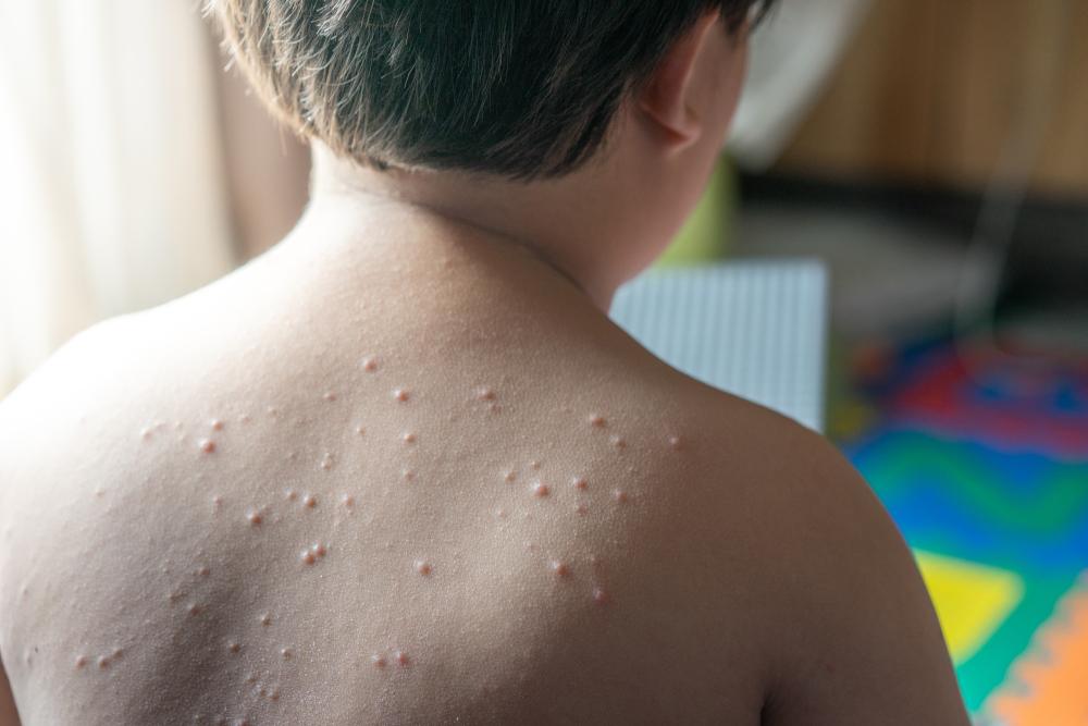 6 Cara Menghilangkan Rasa Gatal Akibat Cacar Air