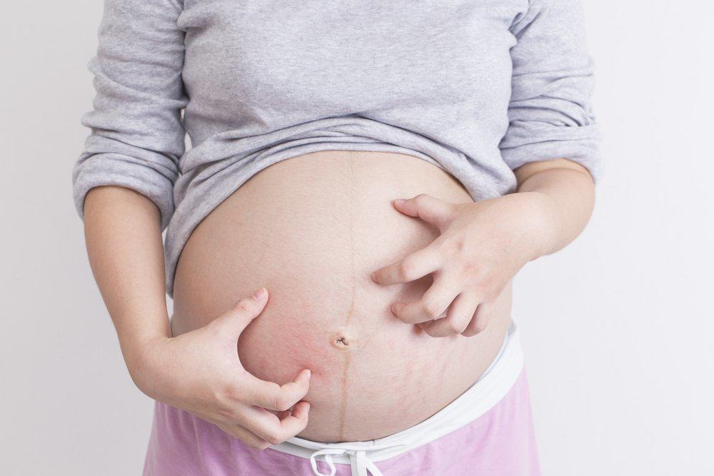 perut gatal saat hamil