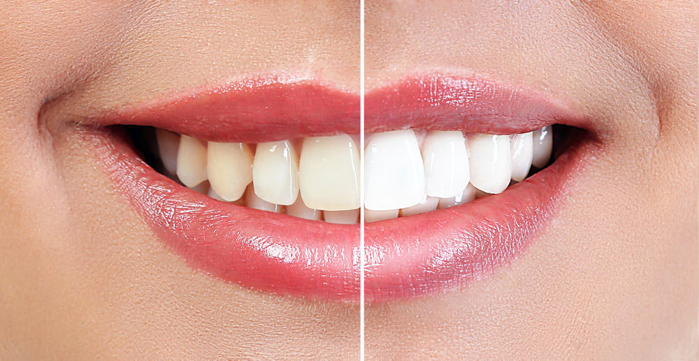 Tips Memutihkan Gigi Dengan Kulit Pisang