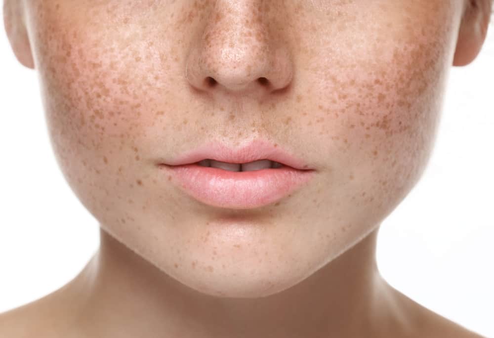 7 Cara Menghilangkan Bintik-Bintik Cokelat di Wajah (Freckles)