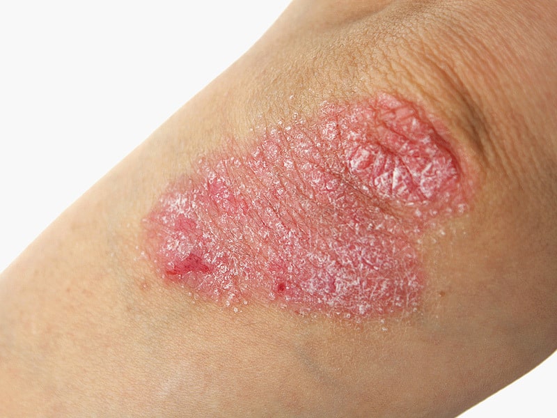 Berbagai Gejala Psoriasis, Baik Secara Umum Maupun Sesuai Jenisnya