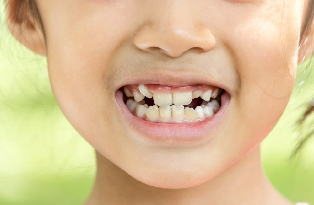 gigi anak tumbuh tidak beraturan