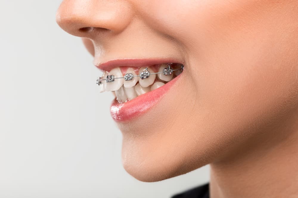 Penyebab Gigi Tonggos dan Pilihan Cara Memperbaikinya