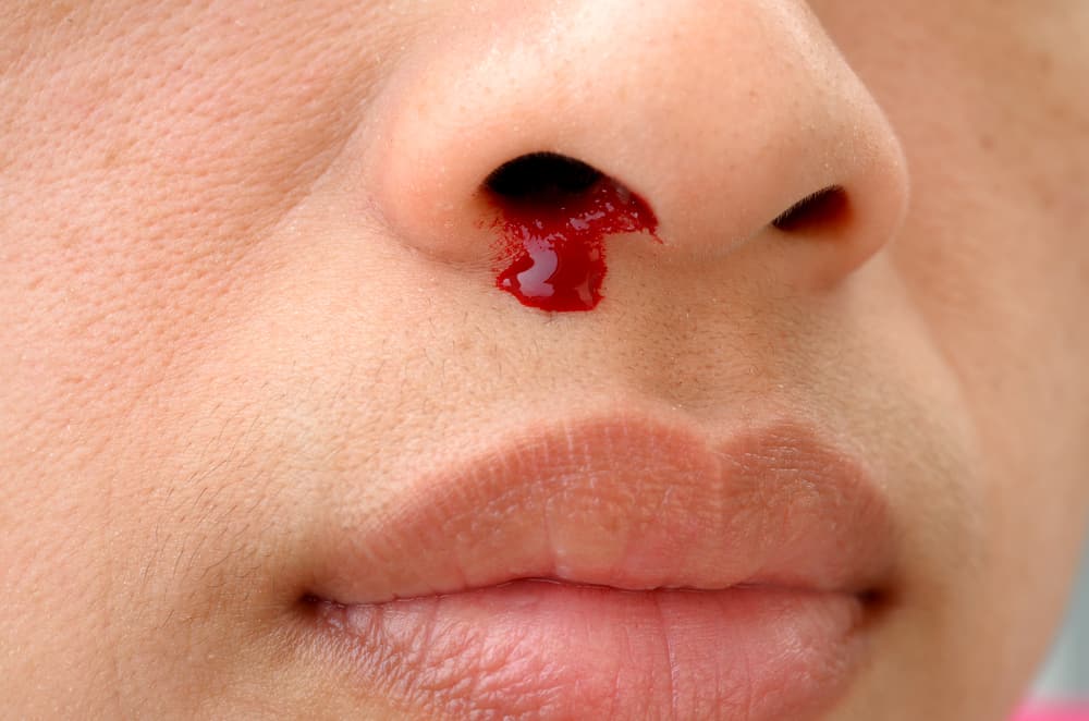 Berdarah sebelah kanan hidung 16 Penyebab