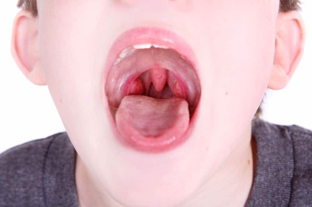 Gejala penyakit tonsilitis adalah