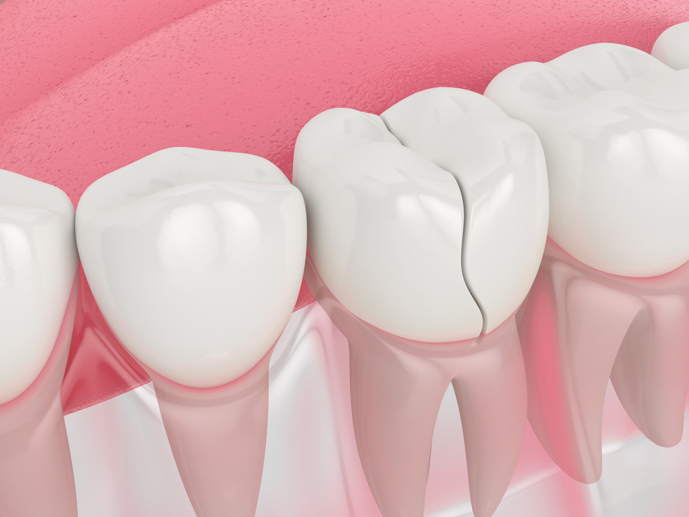 Pahami Penyebab Gigi Retak dan Cara Mengatasinya