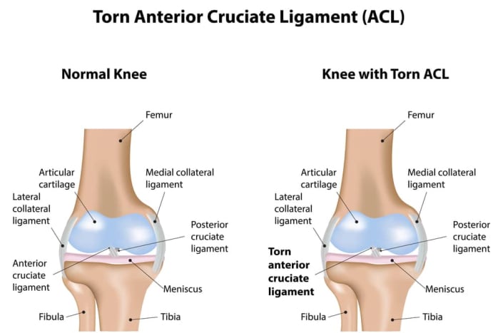 Anterior cruciate ligament