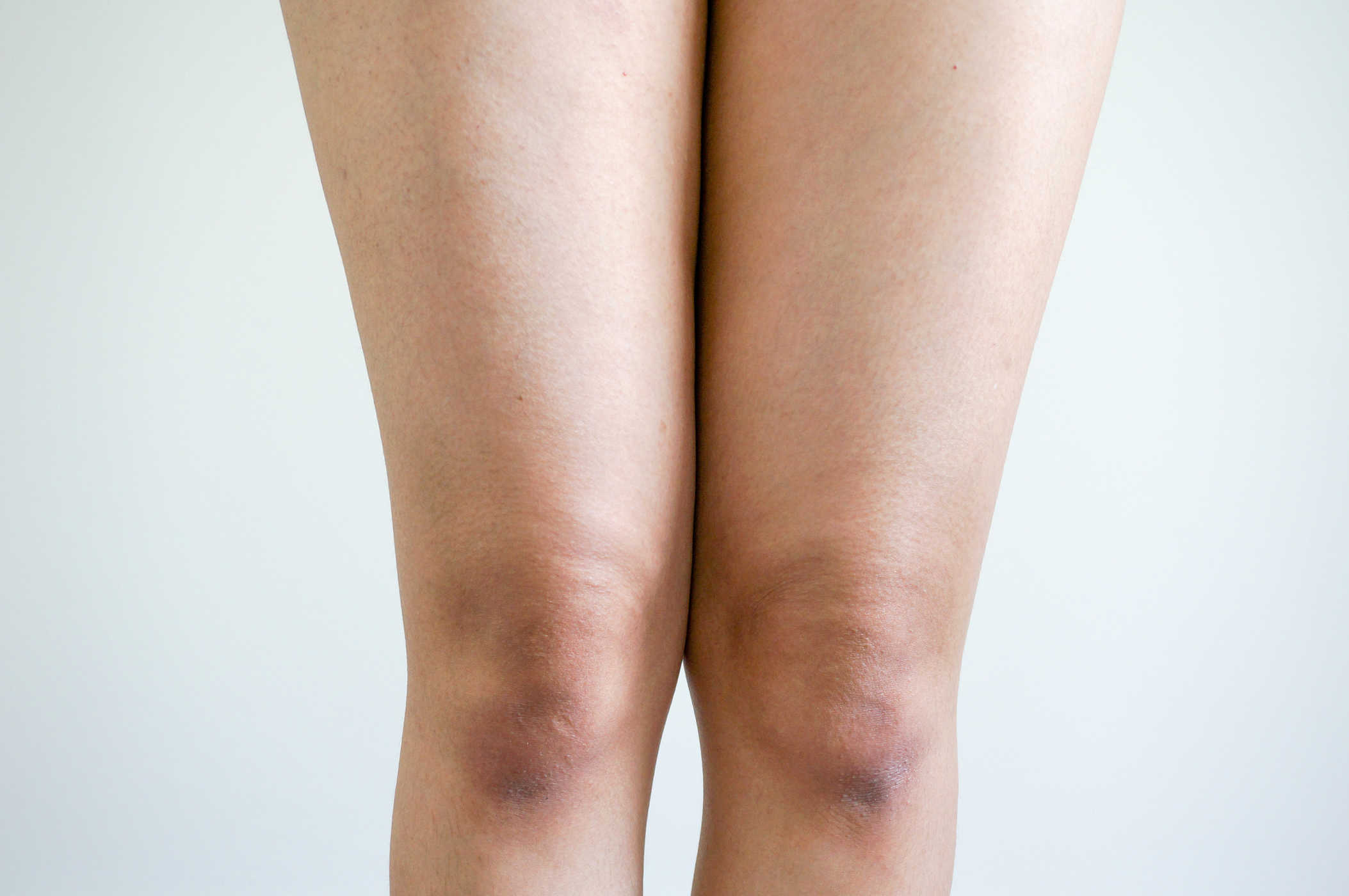 5 Cara Mencerahkan Kulit Siku dan Lutut yang Menghitam
