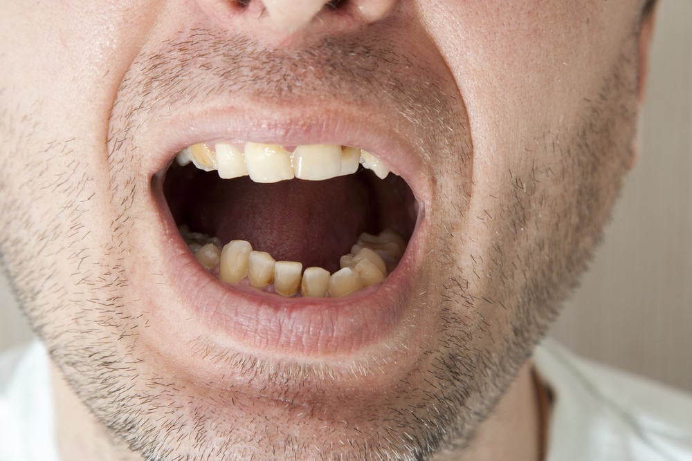 7 Cara Mudah Mencegah Munculnya Karang Gigi