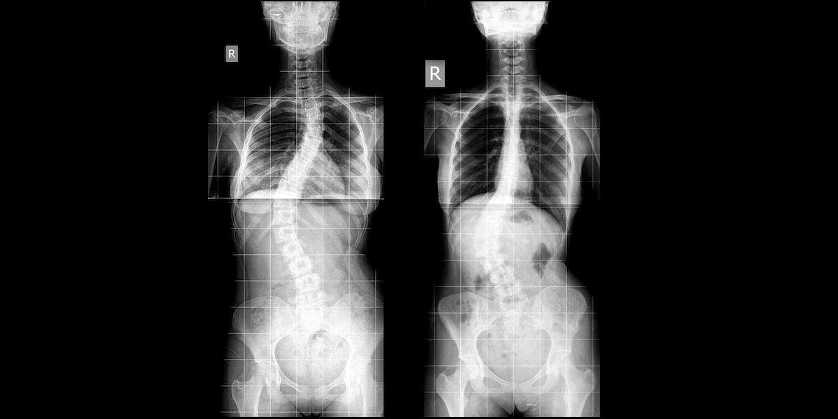 Jenis-jenis Pengobatan untuk Skoliosis untuk Anak dan Dewasa