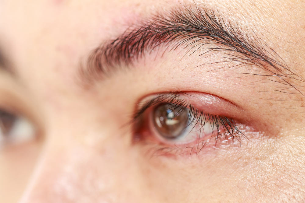 Mengenal Penyebab Mata Bintitan dan Faktor Risikonya