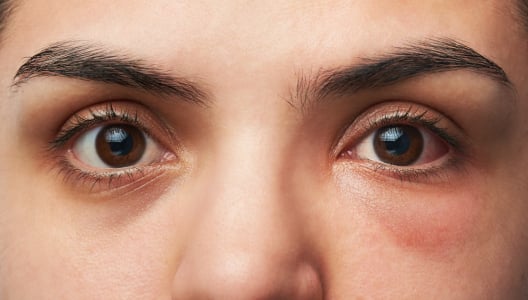 5 Penyebab Infeksi Mata yang Sering Terjadi (Ssst, Bisa Karena Penyakit Kelamin, Lho!)