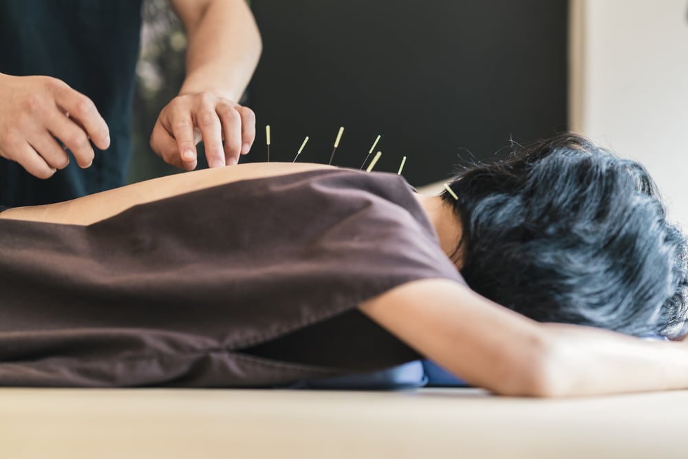 7 Possible Acupuncture Side Effects
